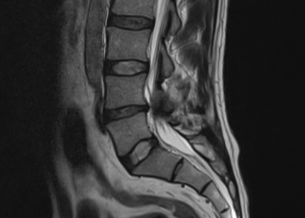  (수술공부)OS:discectomy, laminectomy :추간판 탈출증