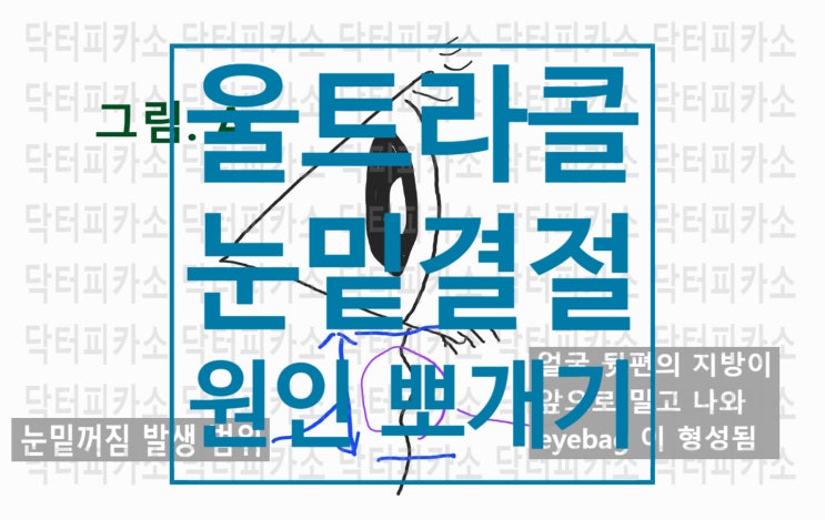  #24.울트라콜 200 눈밑결절 원인 뽀개기(feat. some human errors, 부작용,울트라콜 뽀개기 spin off)