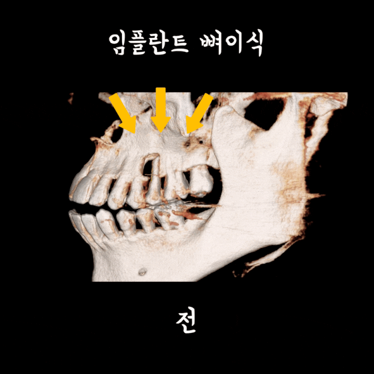  치조골이식 (GBR ,임플란트 뼈이식) 이란?