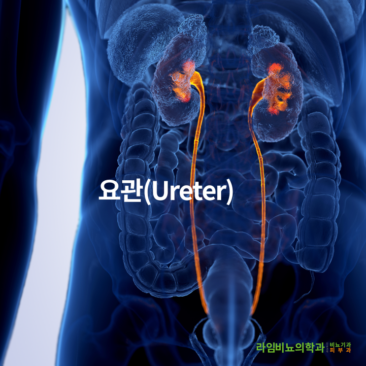  요로결석이 신장결석인가요?