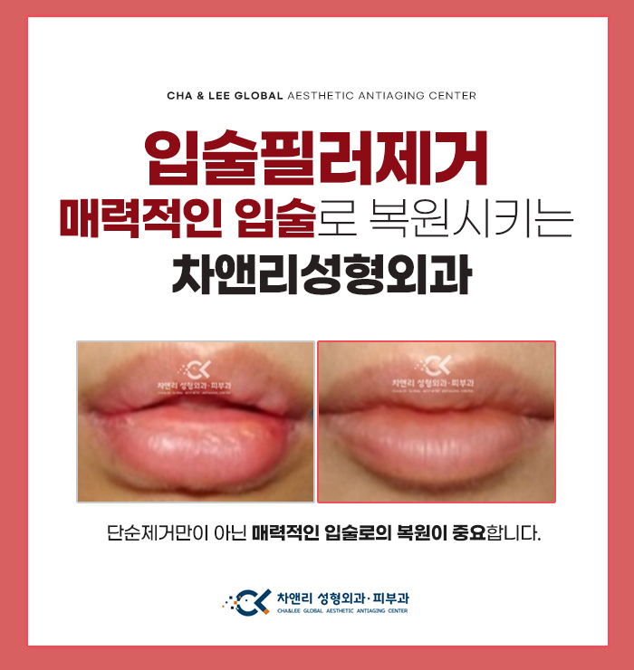  입술필러제거 이상적인 입술모양을 원하신다면