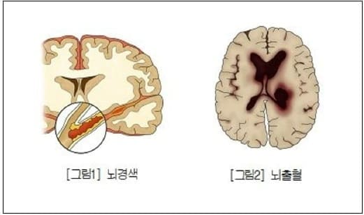  벌써 겨울?...추울수록 무서운 '심혈관질환'