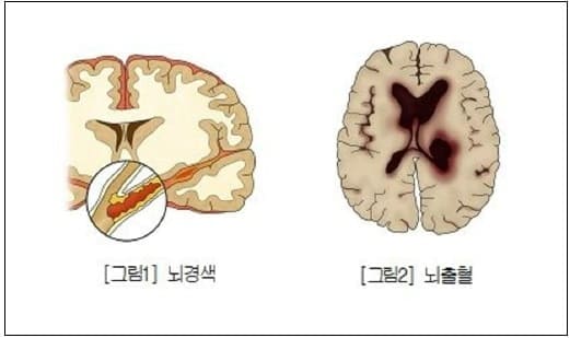 벌써 겨울?...추울수록 무서운 '심혈관질환'