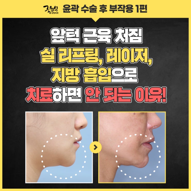  턱끝처짐교정술 원인부터 해결 방법까지 살펴봐요!
