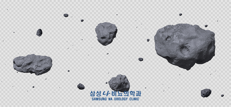도봉구비뇨기과 요로결석의 종류와 발생 원인 (요산부터 시스틴까지) : 네이버 블로그