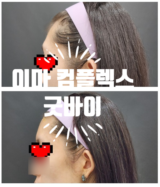  선릉역 피부과 골드제이 의원 납작 이마 필러 1주일 후기