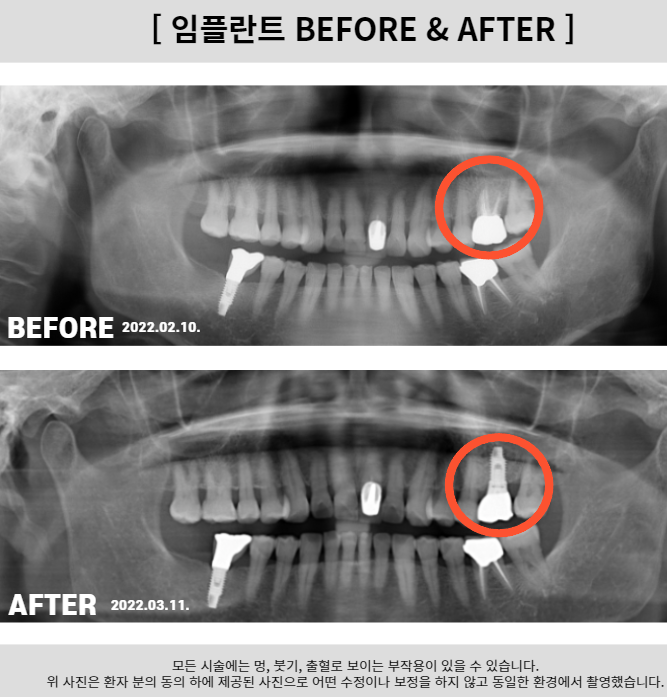  하남뼈이식임플란트 자세히 알려드려요