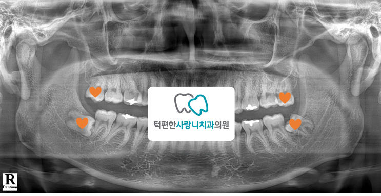 [범계역 매복사랑니발치] 사랑니 4개를 동시에 발치하는 것이 좋을까?