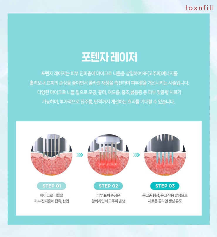 인천 구월동 '포텐자레이저' 모공 여드름흉터 완화