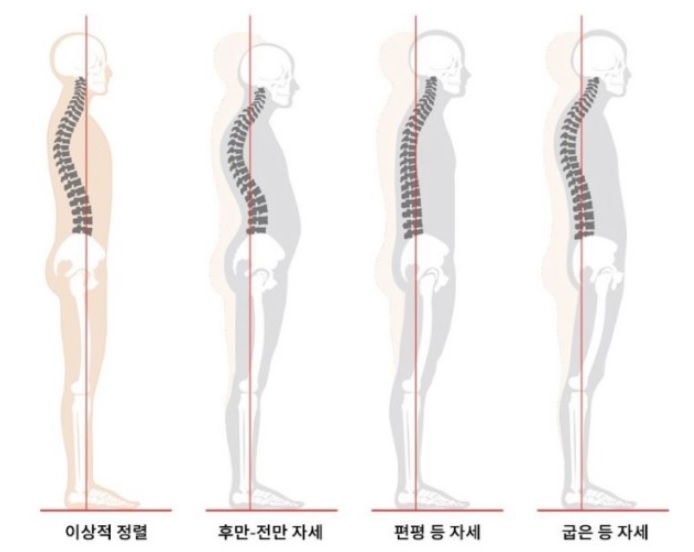  바른자세인 것 같은 내 몸에서 느껴지는 허리통증, 무엇이 문제일까요? (플랫백 / 편평등 )  전주 만성동 법조타운 법리단길 필라테스