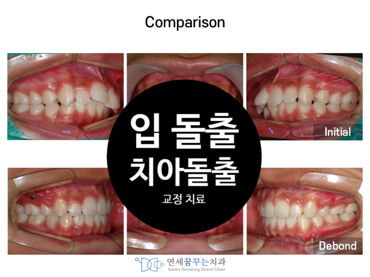 하남에서 치아 돌출입 부정교합 교정치료 전후 비교한다면