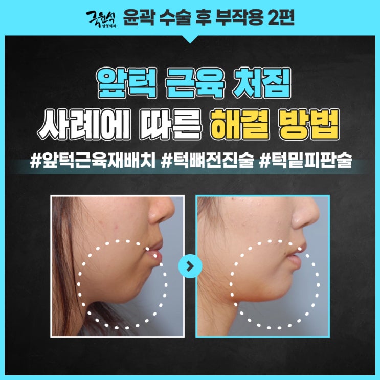  앞턱수술사례 처짐이 생기는 이유와 해결 방안은?