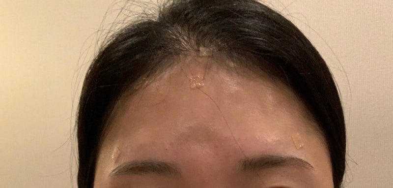 40대 얇은 피부 이마필러 후 5