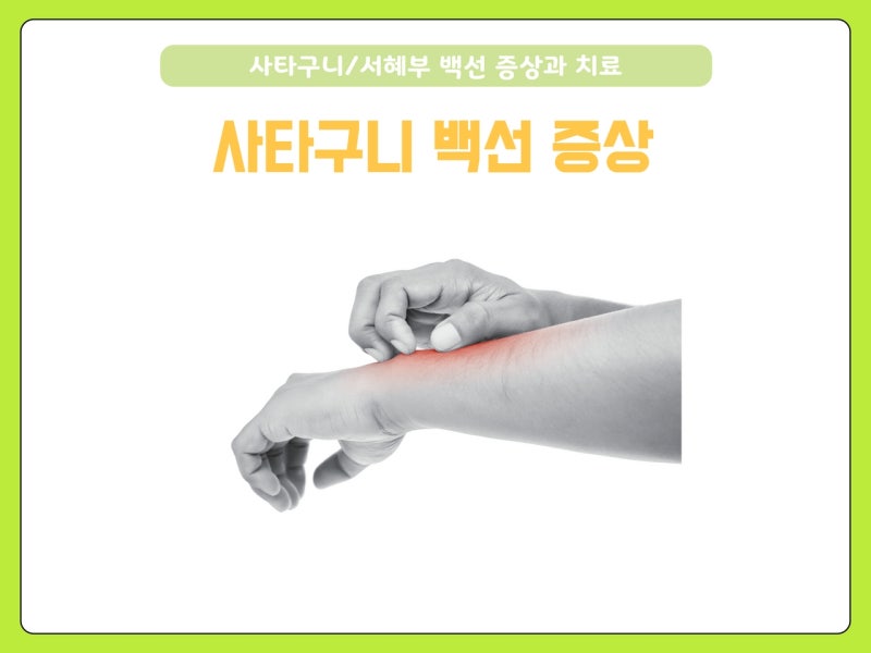 여자 서혜부/ 남자 사타구니 완선(백선) 원인과 증상: 습진, 무좀, 가려움, 음낭, 항문, 연고 : 네이버 블로그
