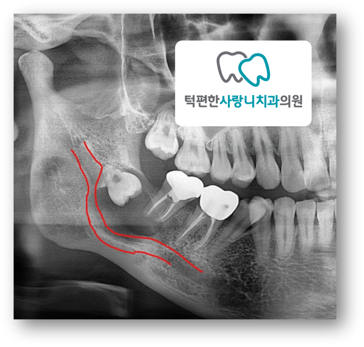  신경에 걸쳐있는 매복사랑니를 뽑으면 감각 이상이 생기나요?