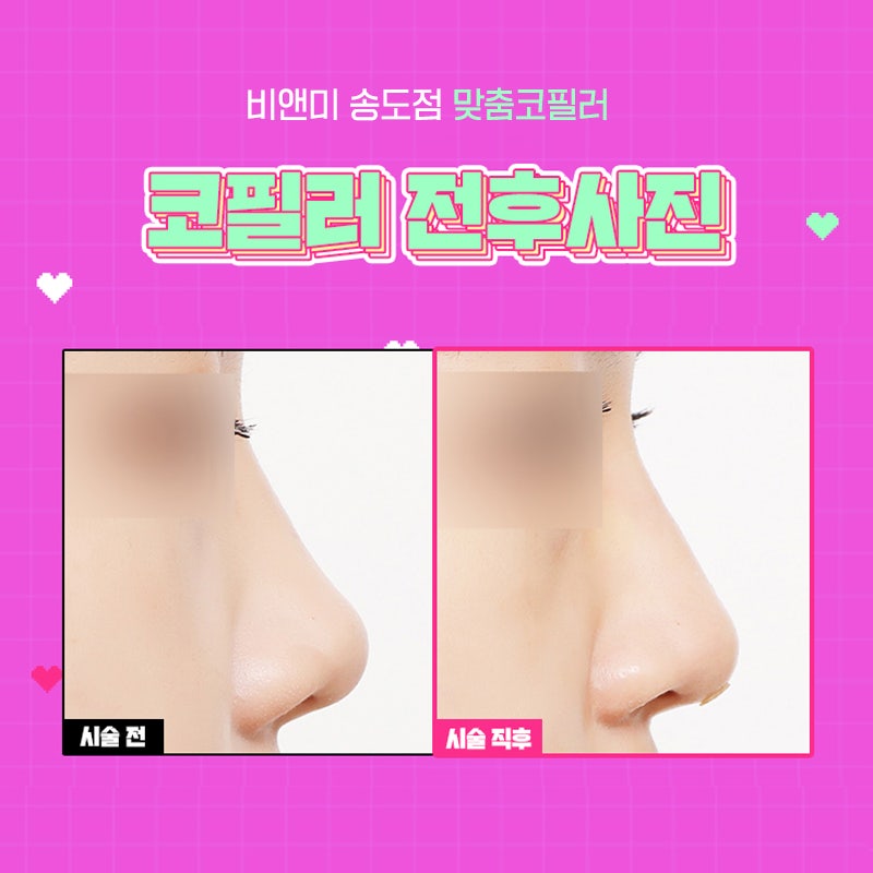 송도코필러 간단한 방법으로