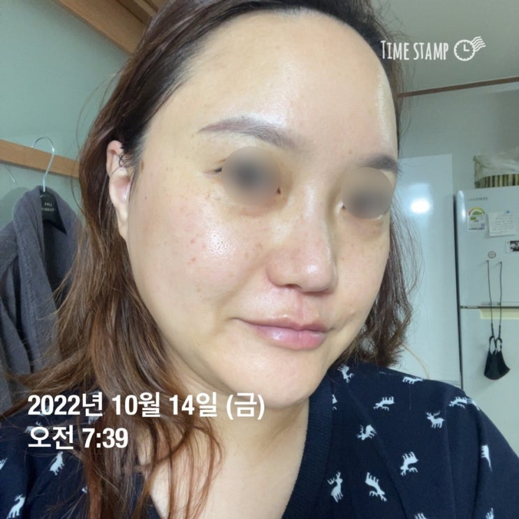 내돈내산 아이소이 ISOI 잡티 세럼 후기