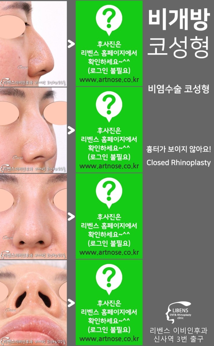 신사역코성형 비염 코수술 재발없이