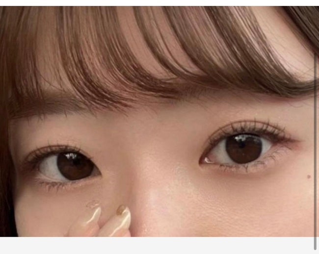  쌍커플 재수술 리얼 후기