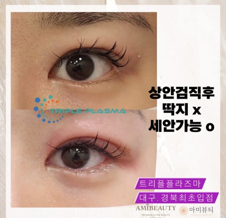  [대구 메디컬스킨케어 아미뷰티] 상안검.하안검.모공.흉터.리프팅. 이젠 데미지없이 트리플플라즈마로 해결하세요 (대구.경북 최초입점 기념 50%할인)