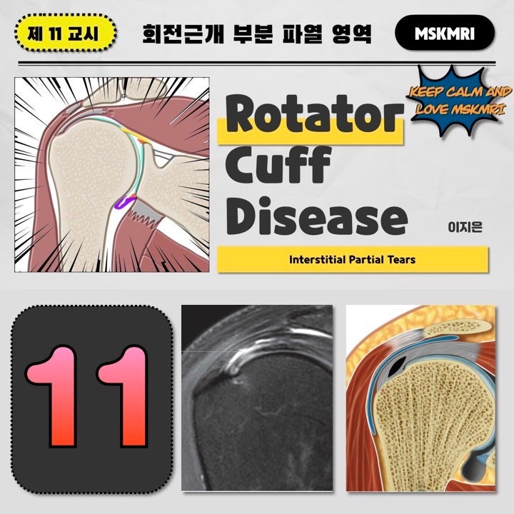  [Rotator cuff Tear 11] Interstitial or intratendinous Rotator Cuff Partial Thickness Tear