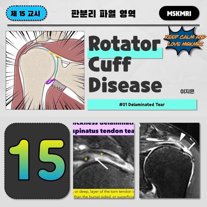  [Rotator cuff Tear 15] #01 Delaminated Tear of Rotator Cuff