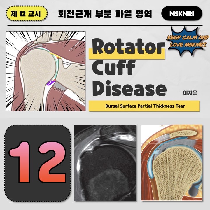  [Rotator cuff Tear 12] Bursal surface Rotator Cuff Partial Tear, reverse PASTA lesion