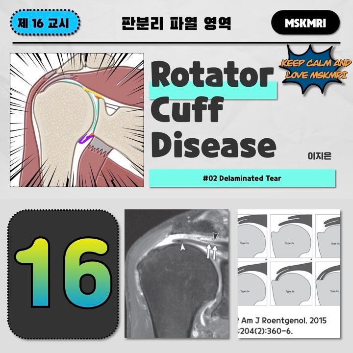  [Rotator cuff Tear 16] #02 Delaminated Tear of Rotator Cuff