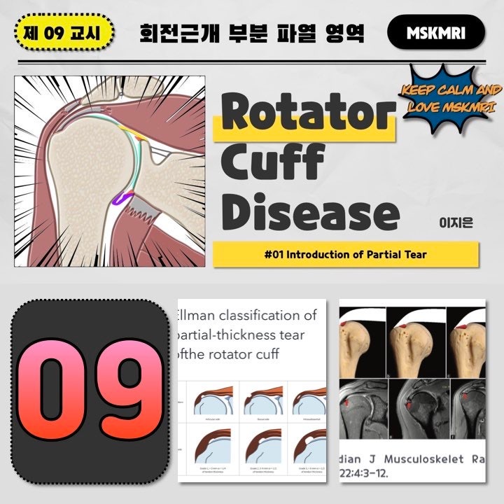 [Rotator cuff Tear 09] #01 Introduction of Rotator Cuff Partial Thickness Tear