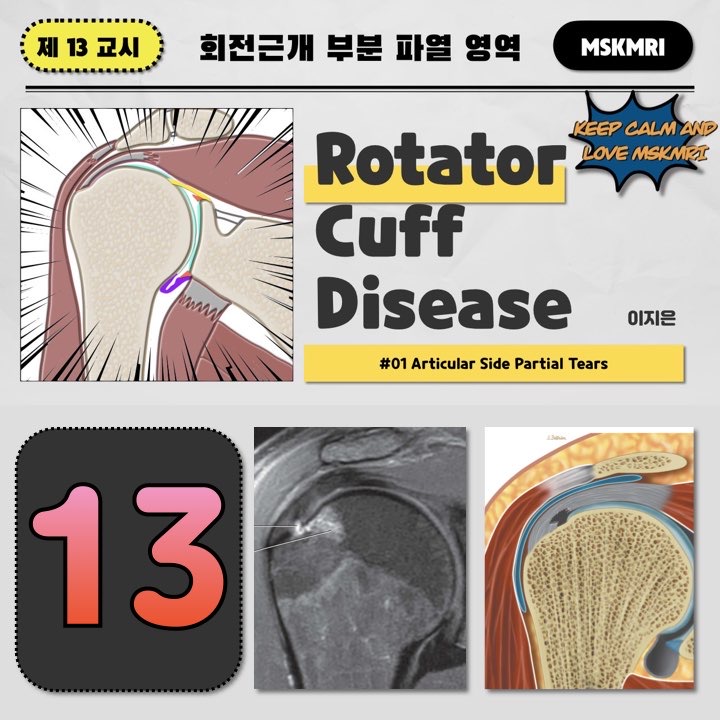  [Rotator cuff Tear 13] #1 Articular Rotator Cuff Partial Tear, PASTA lesion, Rim rent tear