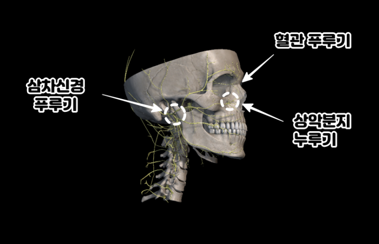  30년 된 비염이 10분 만에 해결? 삼차신경 스도