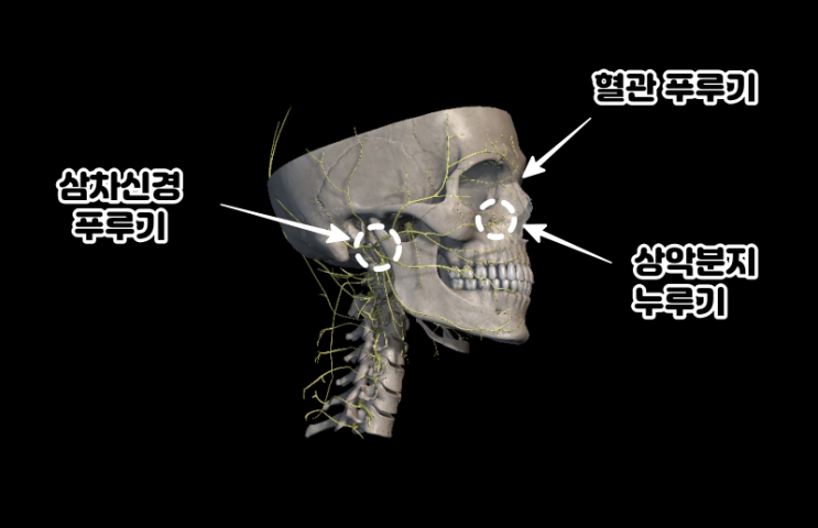 30년 된 비염이 10분 만에 해결? 삼차신경 스도