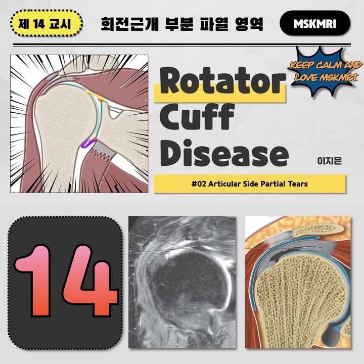  [Rotator cuff Tear 14] #02 Articular Rotator Cuff Partial Tear, PAINT, STAS lesions