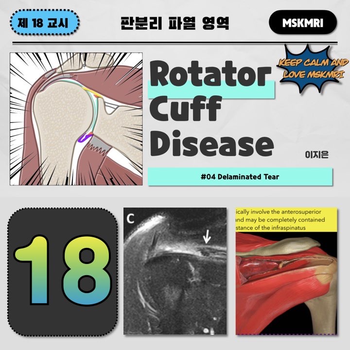  [Rotator cuff Tear 18] #04 Delaminated Tear of Rotator Cuff