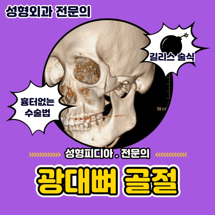 [안면골절] 광대뼈 (관골궁) 골절 (길리스 접근법)