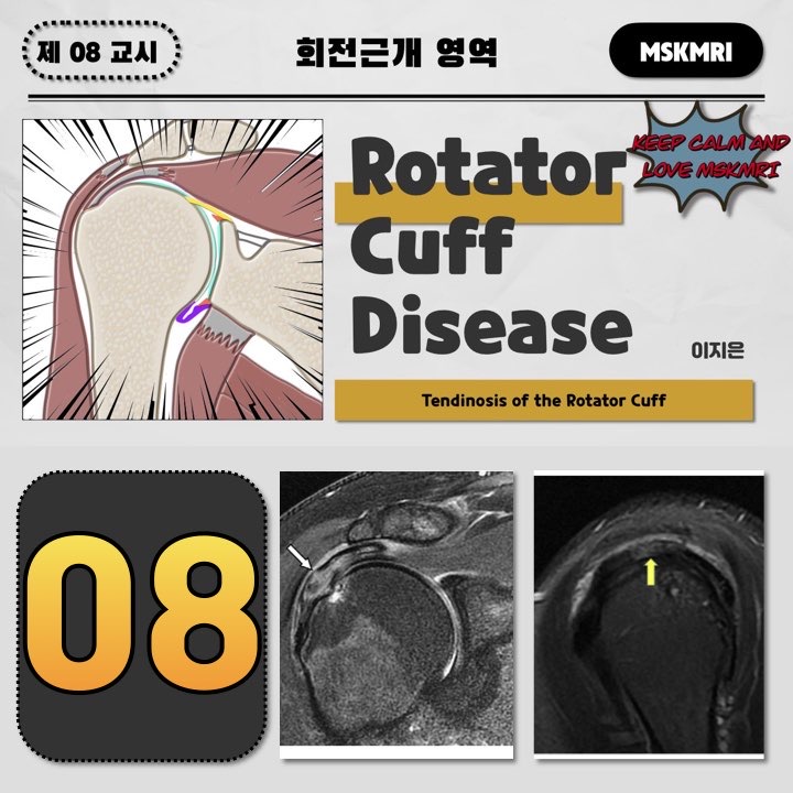  [Rotator cuff Anatomy 08] Tendinosis of the Rotator Cuff