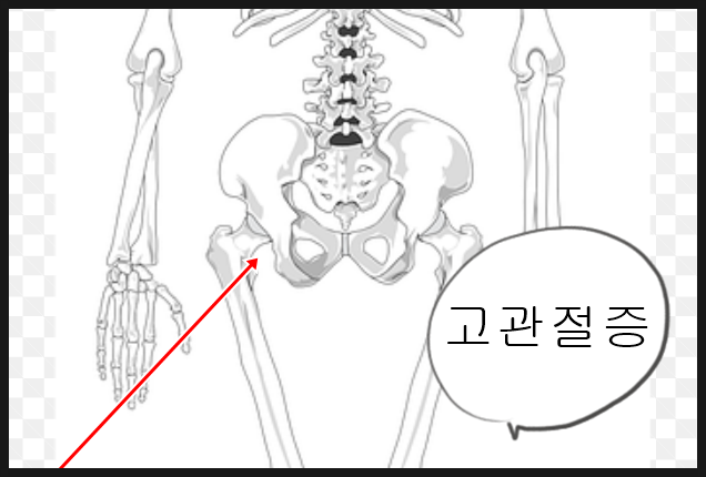  고관절증 증상 및 수술 후기 (별로 아프지 않다?)