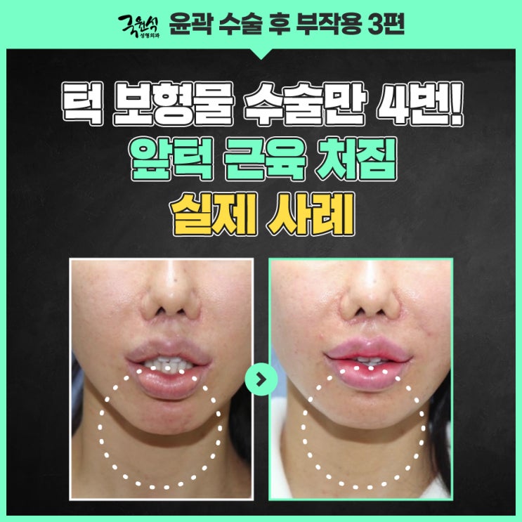  앞턱 처짐으로 턱끝재건병원 알아보고 있어요?