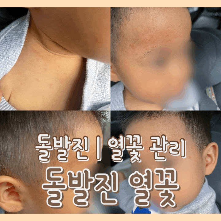  [육아] 돌발진 열이 나고 빨간 열꽃이 피었어요 : 돌발진 증상 / 열꽃vs발진 / 관리방법 / 병원 방문 여부