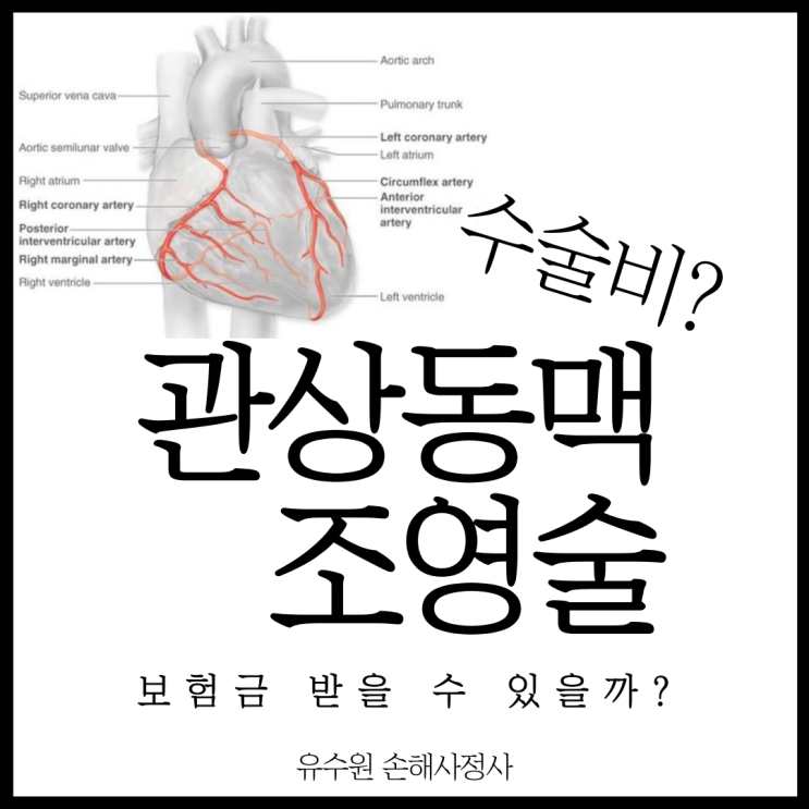  관상동맥조영술 수술비 받을 수 있을까? 이것만 알면 됩니다