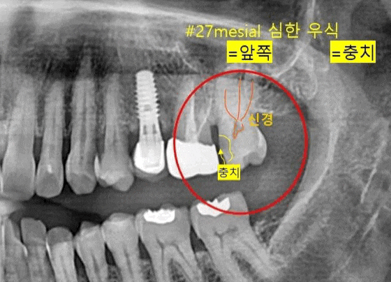  충치 제거 후 신경 치료 방법 및 필요성