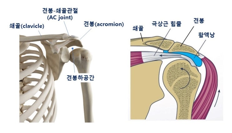  어깨충돌증후군(Shoulder Impingement Syndrome), 돌림근띠(회전근개)파열의 원인과 치료