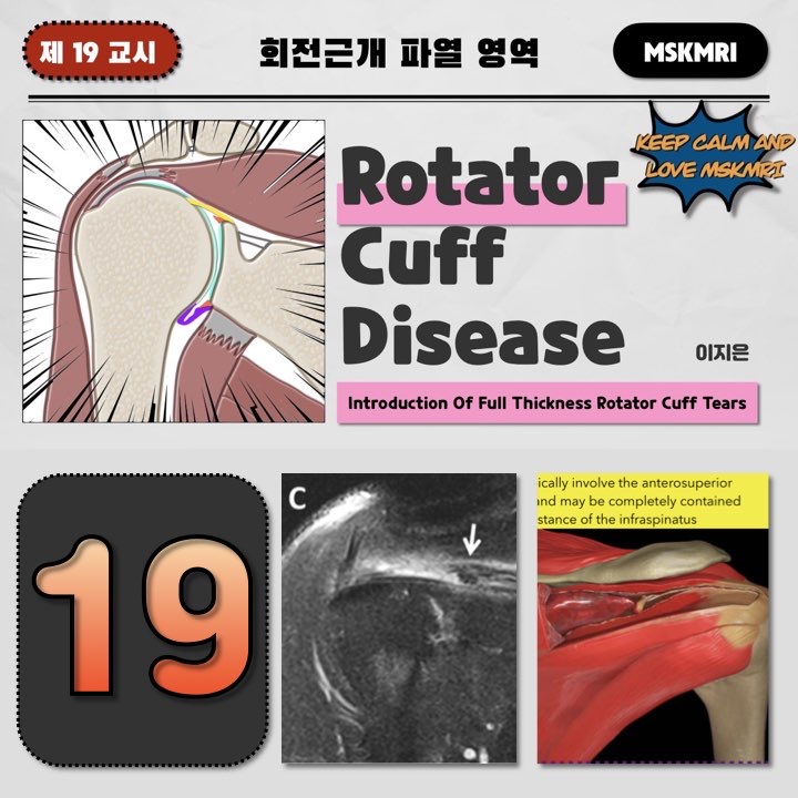  [Rotator cuff Tear 19] Introduction of Full Thickness Rotator Cuff Tears