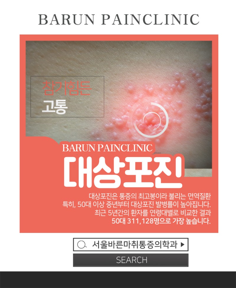 대상포진 증상(초기) 및 원인과 8