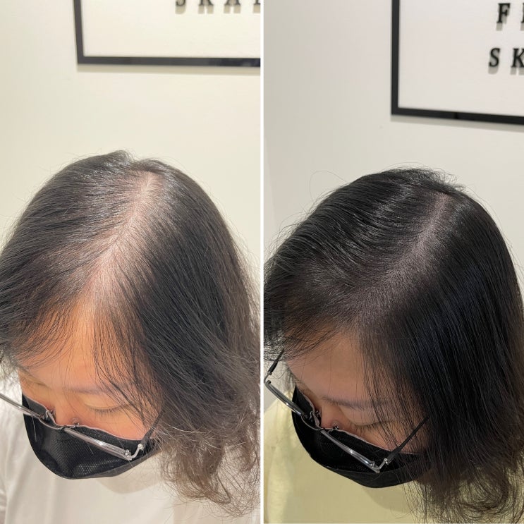  김포산후탈모/김포출산후탈모로 고생하는분이 계신다면 주목해주세요~!!김포탈모커버 전문 필릭스 스칼프