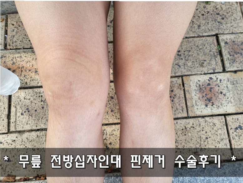 무릎 전방십자인대 핀제거 수술후기
