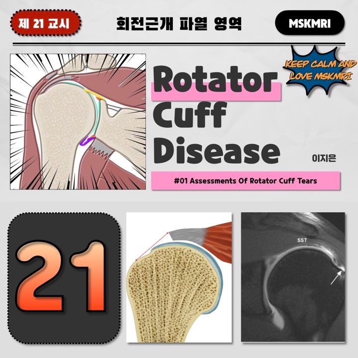  [Rotator cuff Tear 21] #01 Assessments of Rotator Cuff Tears