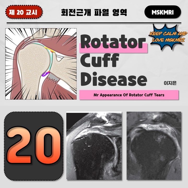  [Rotator cuff Tear 20] MRI findings of Rotator Cuff Tears