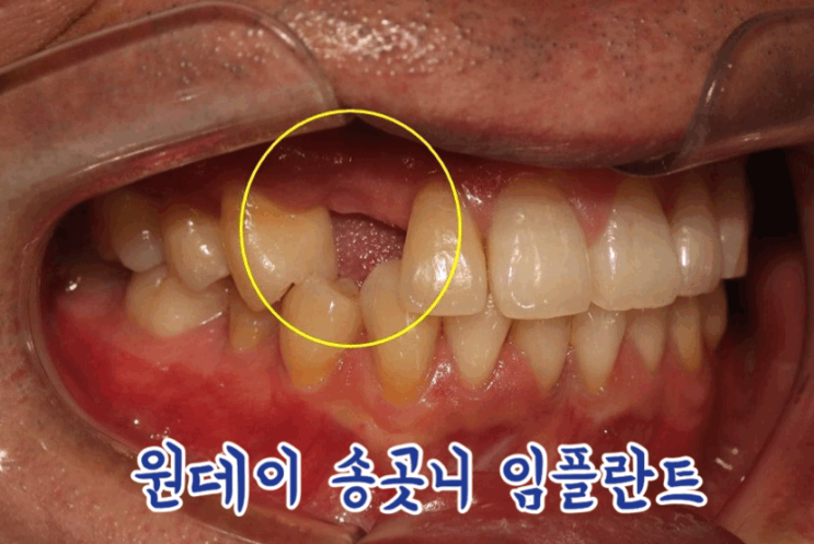  송곳니 임플란트 식립 / 누워있는 매복 사랑니 발치 원데이 치과