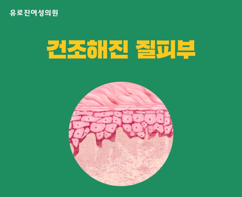 질 건조증의 원인과 Bivivo로 치료할 수 있는 이유 1
